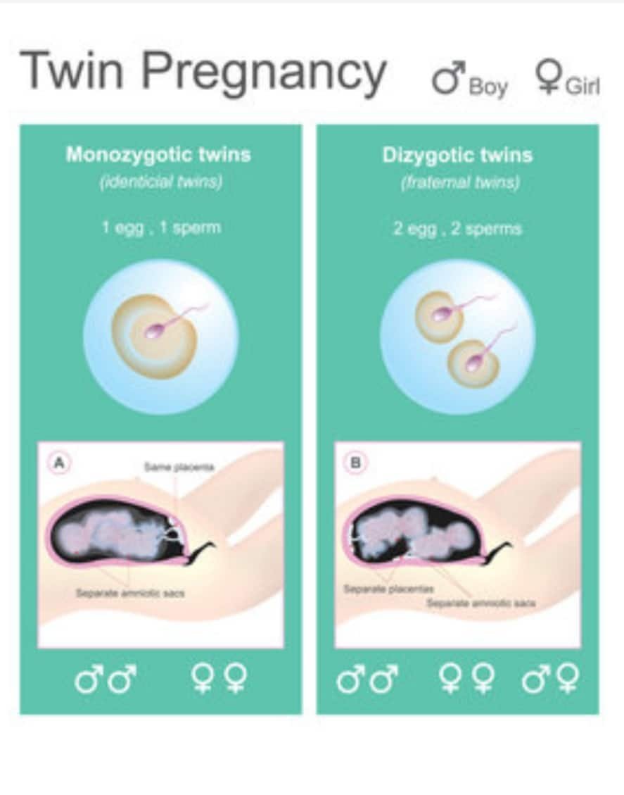 Multiple pregnancy-multiple pregnancies