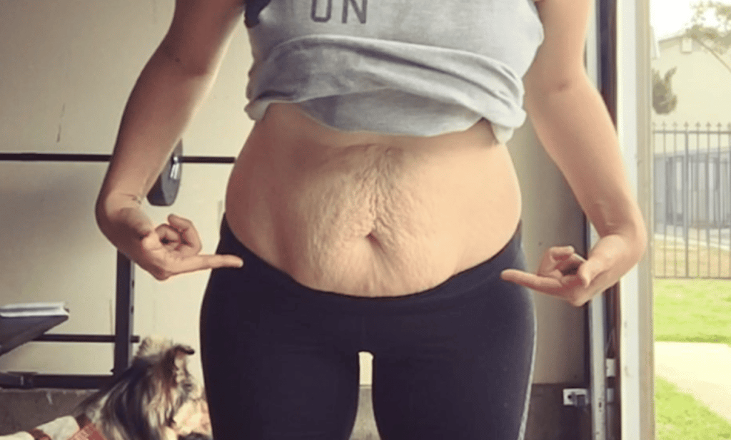 tighten loose skin after pregnancy