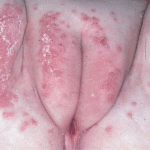 Vulvar skin disorders