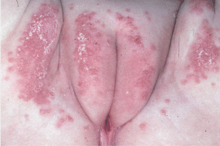 Vulvar skin disorders