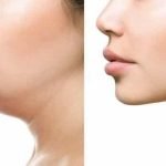 An Extensive Guide to Remove Double Chin Fat Naturally at Home 1
