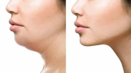 An Extensive Guide to Remove Double Chin Fat Naturally at Home 2