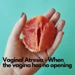 Vaginal Atresia