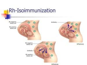 Rhesus Isoimmunization