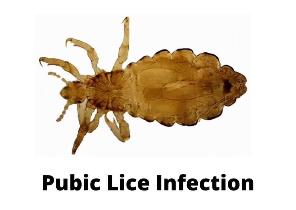 A Must Know About The Std Pubic Lice Infection Pediculosis