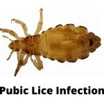 Pubic Lice Infection