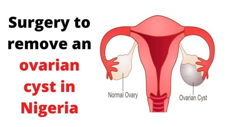 ovarian cyst