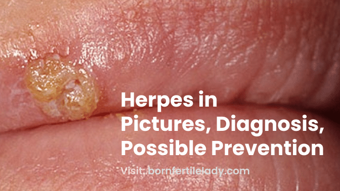 Herpes in Pictures, Diagnosis, Possible Prevention