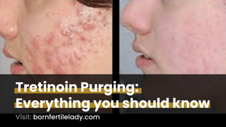 Tretinoin Purging