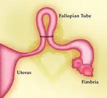 Tubal ligation