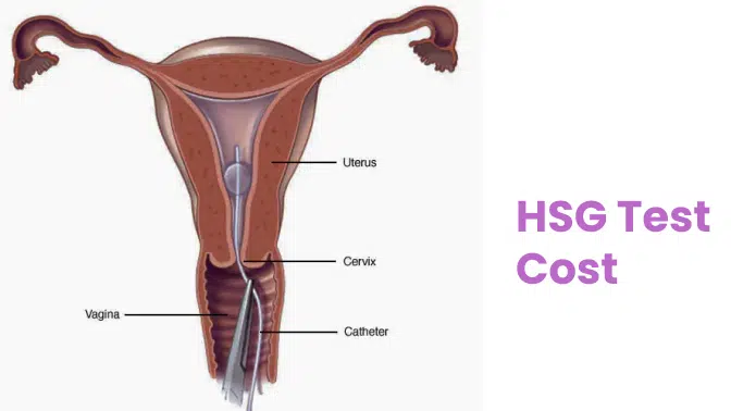 HSG Test Cost: A Comprehensive Guide to Understanding and Managing Expenses