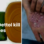 "Can Dettol Kill Scabies?" 1