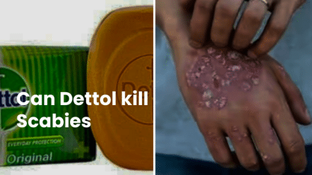 "Can Dettol Kill Scabies?" 4