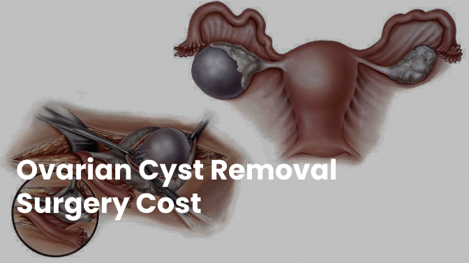 Understanding Ovarian Cyst Removal Surgery Costs 1