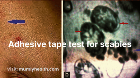 Adhesive tape test for scabies
