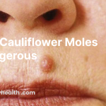 Are Cauliflower Moles Dangerous