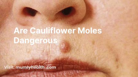Are Cauliflower Moles Dangerous