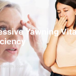 Excessive Yawning Vitamin Deficiency
