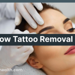 Eyebrow Tattoo Removal
