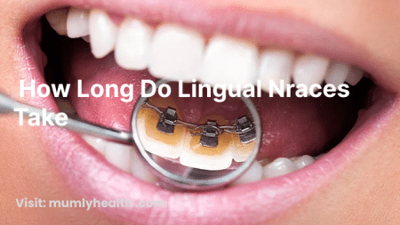 how long do lingual braces take