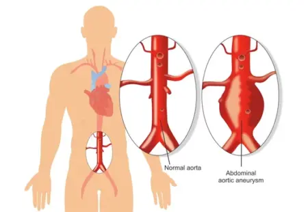 Abdominal Aortic Aneurysm: An Overview 6