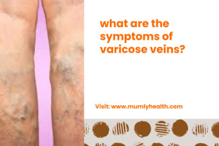 what are the symptoms of varicose veins_