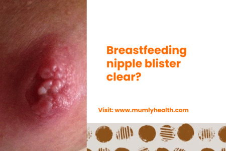 Breastfeeding nipple blister clear_
