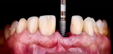 The Blueprint for Dental Implant Marketing Success: Essential Keys Revealed 7